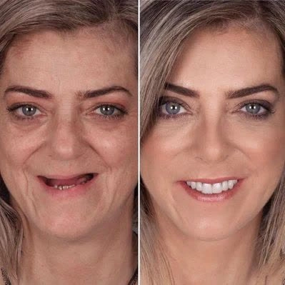 چهره ای جوان و شاداب با فول دنچر