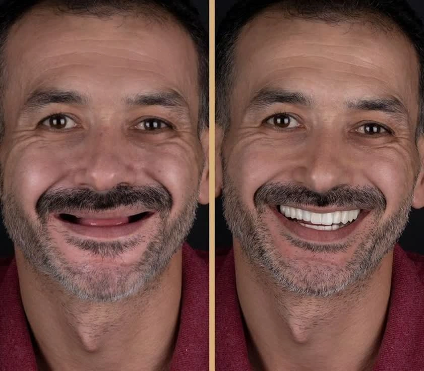 چهره ای جوان و شاداب بعد از فول دنچر